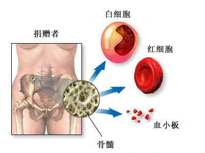 骨髓移植治愈艾滋病